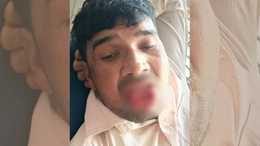 জোর চুম্বনের চেষ্টায় প্রেমিকের জিহ্বা কামড়ে দিলেন তরুণী