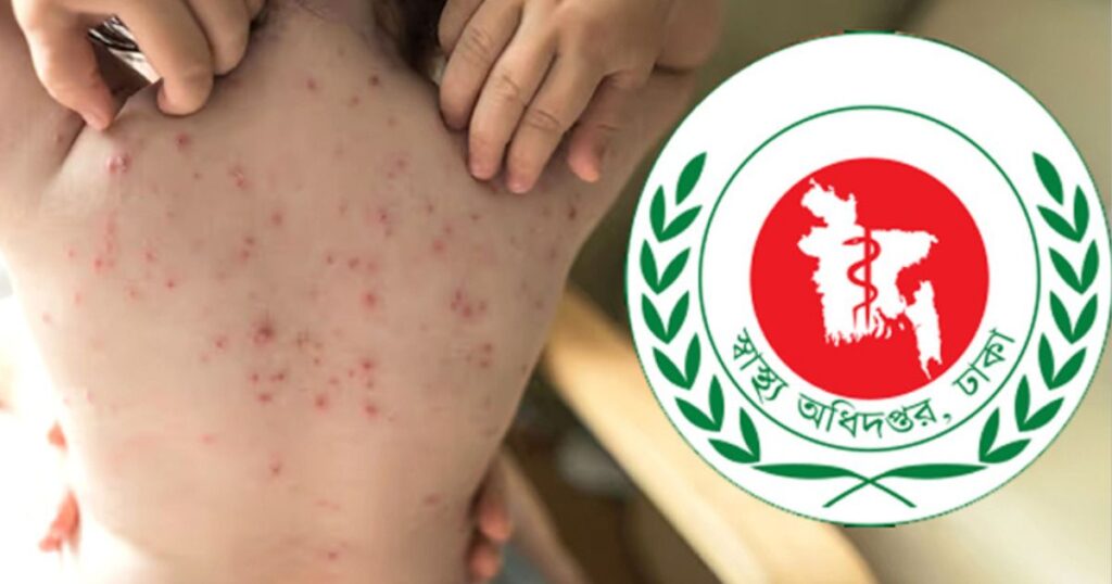 গত ২৪ ঘণ্টায় হাম ও উপসর্গে আরও ৫ শিশুর মৃত্যু